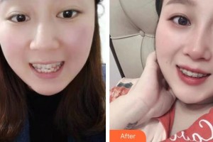 永康胡韻口腔門診部楊文雅整形價格表附牙齒隱形矯正案例展示