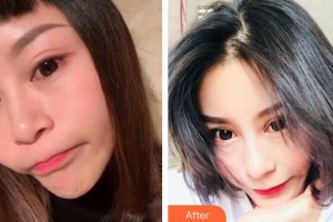 永康康利眼科醫(yī)院王開元整形價格表附切開雙眼皮案例展示