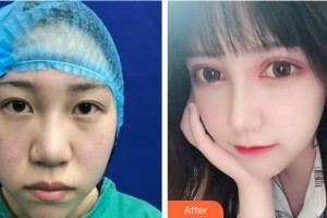 永康康利眼科醫(yī)院施靈毅整形價格表附切開雙眼皮案例展示