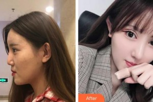 清遠養(yǎng)和整形美容醫(yī)院李超整形價格表附鼻部綜合案例展示