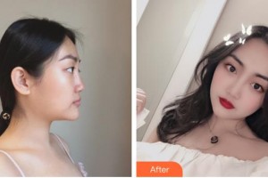 清遠市人民醫(yī)院整形美容科唐夏住院醫(yī)師整形價格表附耳軟骨復合隆鼻案例展示