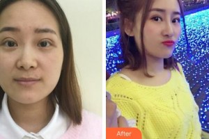 清遠華美整形外科門診部丘金俊整形價格表附鼻部綜合案例展示