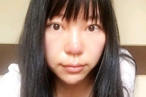 長春西之米林鐘學(xué)隆胸手術(shù)附果圖+案例分享