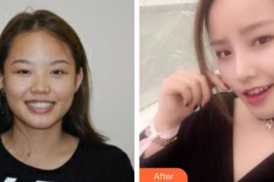 南華大學附屬第二醫(yī)院醫(yī)療美容科曾健整形價格表附鼻部綜合案例展示