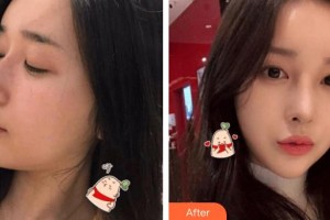 南華大學附屬第二醫(yī)院醫(yī)療美容科蔣斌整形價格表附鼻骨矯正案例展示