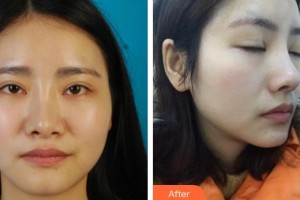 佛山曙光金子醫(yī)學(xué)美容醫(yī)院王業(yè)勝整形價格表附鼻部綜合案例展示