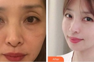 佛山華廈眼科醫(yī)院張弛整形價格表附眼部綜合案例展示