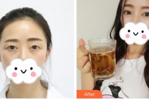 佛山華廈眼科醫(yī)院黎嬋余整形價格表附定點雙眼皮案例展示