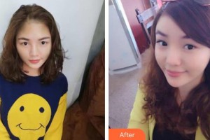 佛山華廈眼科醫(yī)院吳國基整形價格表附切開雙眼皮案例展示