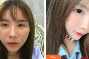 佛山華廈眼科醫(yī)院王騫整形價格表附眼部整形下眼下至術案例展示