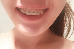 成都極光口腔醫(yī)院牙齒矯正多少錢附手術(shù)過程分享