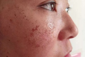 蘭州大學(xué)第二醫(yī)院祛斑附恢復(fù)對比圖