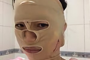 重慶時(shí)光整形美容醫(yī)院姜民范磨骨手術(shù)果怎么樣附較新價(jià)格表