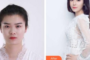 皖北煤電集團總醫(yī)院醫(yī)學美容中心劉艷菊整形價格表附假體隆鼻案例展示