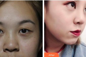 皖北煤電集團總醫(yī)院醫(yī)學美容中心毛秋影住院醫(yī)師整形價格表附鼻部綜合案例展示