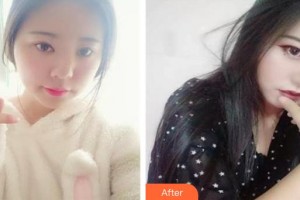 黃河中心醫(yī)院整形美容中心杜楓整形價格表附鼻部綜合案例展示