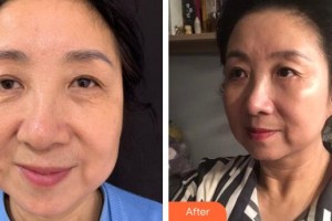 普寧市人民醫(yī)院眼科黃伯健整形價格表附內切祛眼袋案例展示