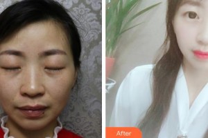 普寧市人民醫(yī)院眼科陳俊洪整形價格表附開內眼角案例展示