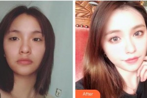 普寧市人民醫(yī)院眼科張建珠整形價格表附切開雙眼皮案例展示