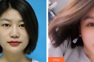 廣空后勤醫(yī)院整形美容中心黃社棟整形價(jià)格表附眼部綜合案例展示