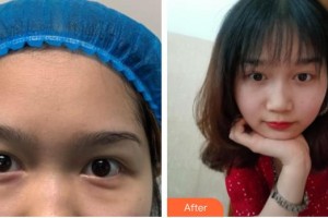 廣空后勤醫(yī)院整形美容中心張靜整形價(jià)格表附切開雙眼皮案例展示