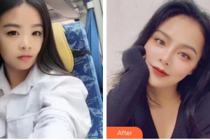 廣空后勤醫(yī)院整形美容中心劉峰整形價(jià)格表附眼部綜合案例展示