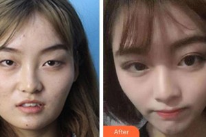 廣空后勤醫(yī)院整形美容中心冼紀(jì)雯整形價(jià)格表附眼部綜合案例展示