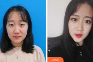 連云港美締整形美容診所李海詩整形價(jià)格表附切開雙眼皮案例展示