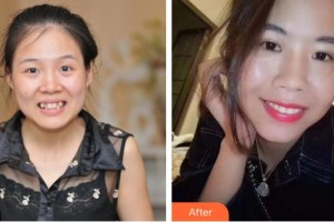 連云港成宏口腔醫(yī)院籍增平整形價(jià)格表附自鎖托槽矯正案例展示