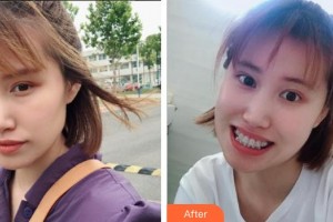 西昌玥美整形美容醫(yī)院湯穎峰整形價(jià)格表附金屬托槽矯正案例展示