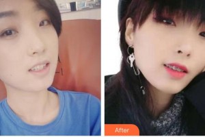 西昌口腔醫(yī)院李華君整形價(jià)格表附金屬托槽矯正案例展示