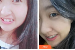 西昌口腔醫(yī)院葉青整形價(jià)格表附金屬托槽矯正案例展示