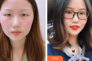 南昌大學(xué)附屬眼科醫(yī)院張旭整形價(jià)格表附切開雙眼皮案例展示