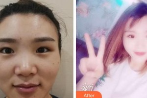 南昌大學附屬眼科醫(yī)院程玲整形價格表附切開雙眼皮案例展示