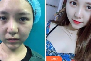 南昌大學附屬眼科醫(yī)院廖洪斐整形價格表附眼部綜合案例展示