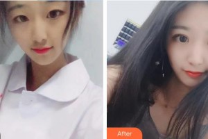 南昌大學附屬眼科醫(yī)院魯宇容整形價格表附眼部綜合案例展示