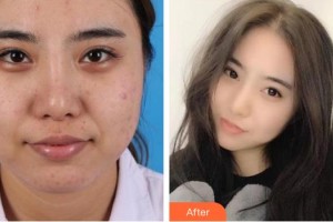 南昌大學附屬眼科醫(yī)院黃琴整形價格表附眼部修復(fù)案例展示