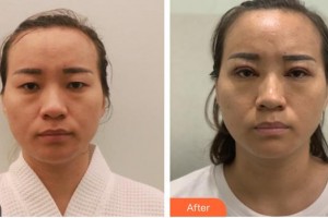 南昌大學(xué)附屬眼科醫(yī)院古學(xué)軍整形價(jià)格表附眼部綜合案例展示