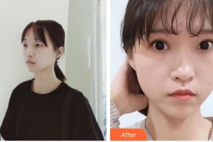 南昌大學(xué)附屬眼科醫(yī)院甘莆英整形價(jià)格表附眼部綜合案例展示