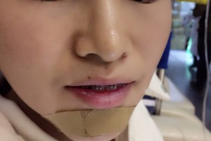 上海長海醫(yī)院徐志云牙齒矯正果好不好附案例和較新價格表