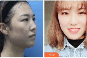 南昌大學(xué)附屬眼科醫(yī)院王安安整形價(jià)格表附切開雙眼皮案例展示