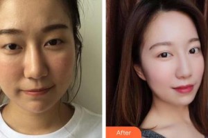 南昌大學(xué)附屬眼科醫(yī)院劉盛濤整形價(jià)格表附激光去黑眼圈案例展示