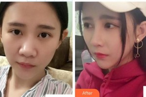 南昌愛爾眼科醫(yī)院黃海整形價格表附切開雙眼皮案例展示