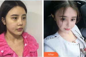 南昌愛視眼科醫(yī)院肖俊華整形價(jià)格表附眼部綜合案例展示