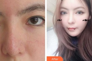 南昌普瑞眼科醫(yī)院高昭輝整形價(jià)格表附切開雙眼皮案例展示