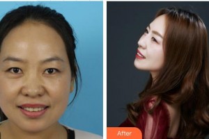 南昌普瑞眼科醫(yī)院吳慧鶯整形價(jià)格表附眼部綜合案例展示