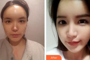 南昌愛爾眼科醫(yī)院楊秋艷整形價(jià)格表附切開雙眼皮案例展示