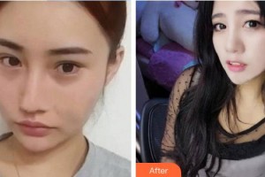 東南大學(xué)附屬中大醫(yī)院整形外科寧官森整形價格表附鼻部綜合案例展示