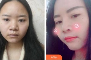 皖南醫(yī)學(xué)院弋磯山醫(yī)院整形外科朱唯力整形價格表附鼻部綜合案例展示