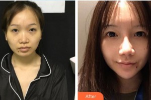 雞西王醫(yī)生整形外科門診部吳政諺整形價(jià)格表附鼻部綜合案例展示